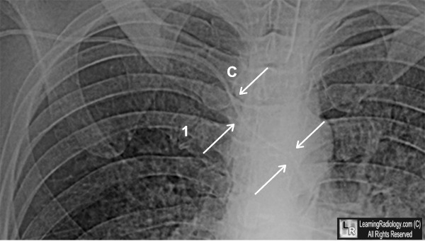 Arterial Placement of Central Line
